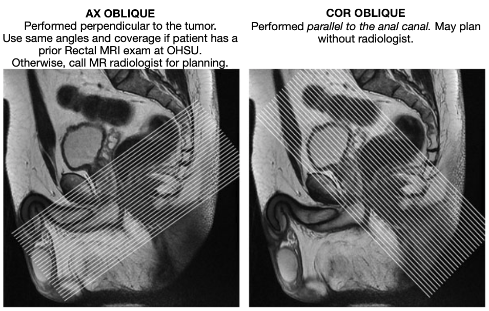 Rectal Cancer Protocol Mri Radiology Reference Articl vrogue.co